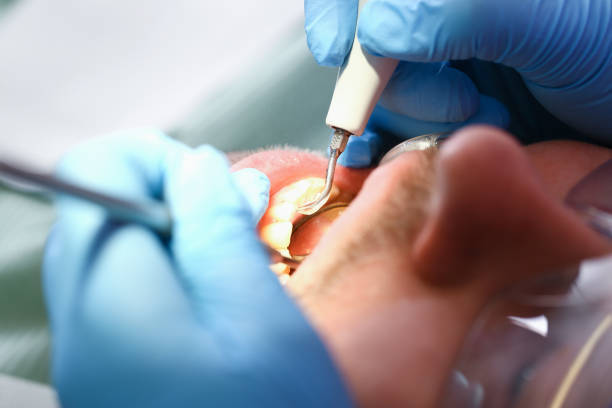 Best Emergency Wisdom Teeth Removal in East Palatka, FL